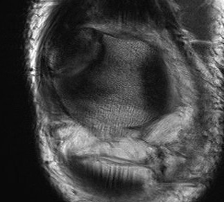 Bipartite patella MRI